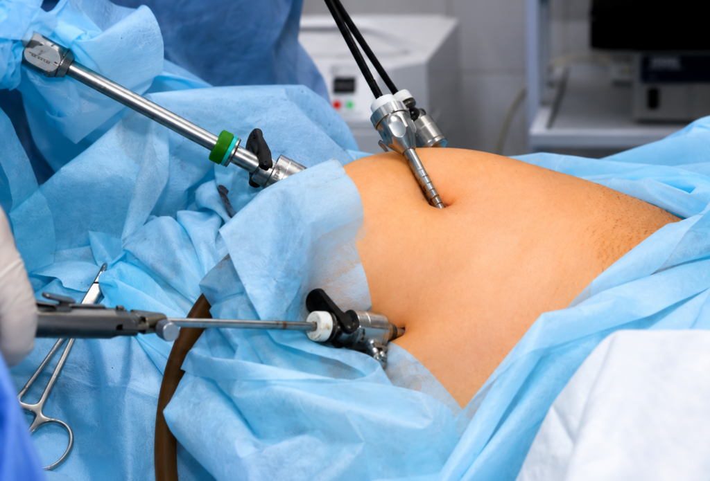 Bariatric Surgery